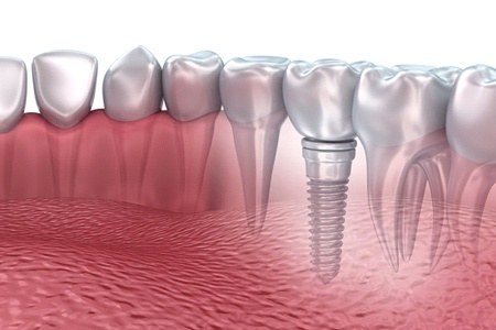 dental implant in the lower jaw