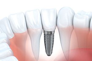 single dental implant in the lower jaw
