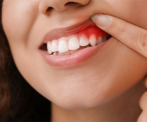 Woman pulling up lip to show inflamed gums