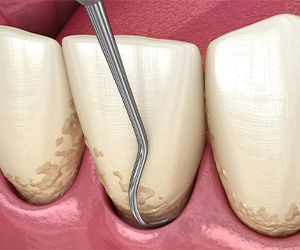 Illustration of scaling and root planing for gum disease treatment in Mesquite