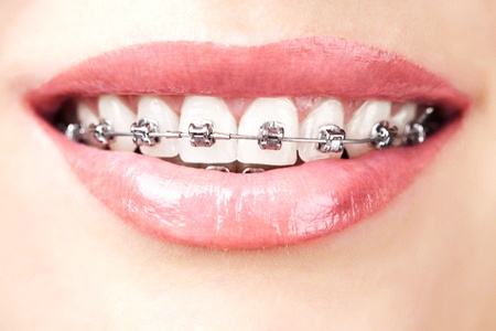 person smiling with traditional braces in Mesquite